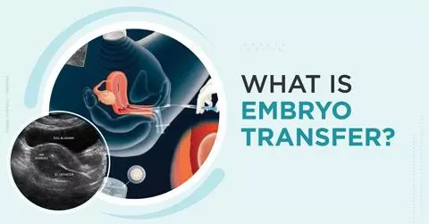 Understanding Embryo Transfer: What It Is and How It Works