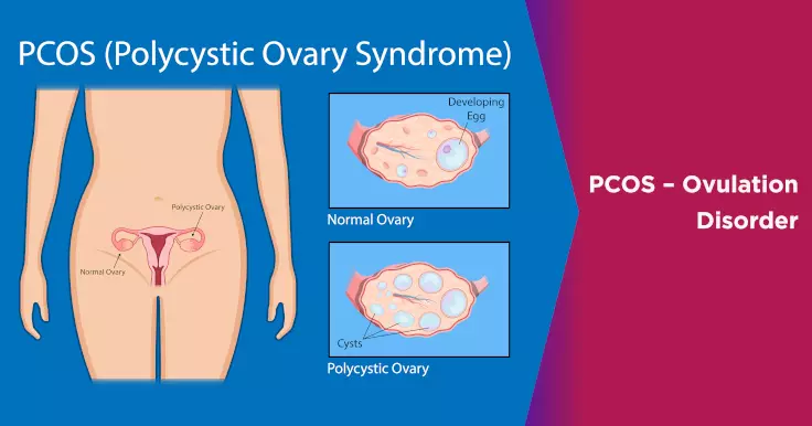 How PCOS is Related to Ovulation Disorders: Understanding the Connection