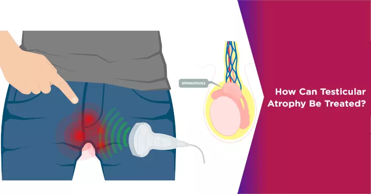  Testicular Atrophy Treatment: How to Address Testicle Shrinkage