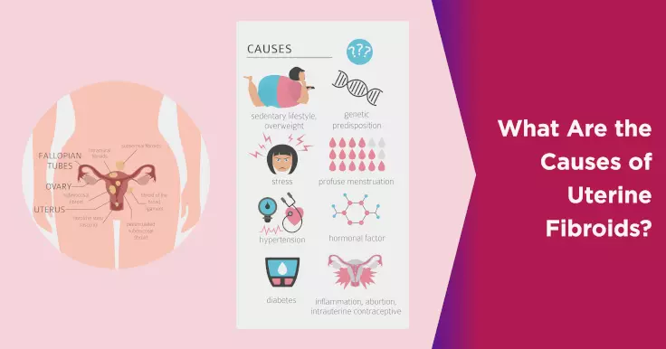  Exploring the Causes of Uterine Fibroids