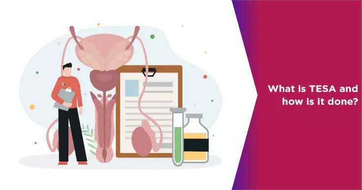 Testicular Sperm Aspiration (TESA): A Key Procedure for Male Infertility Treatment