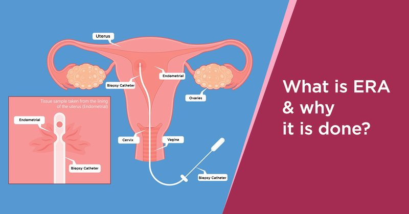 Endometrial Receptivity Array Procedure