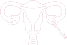 Ovarian PRP